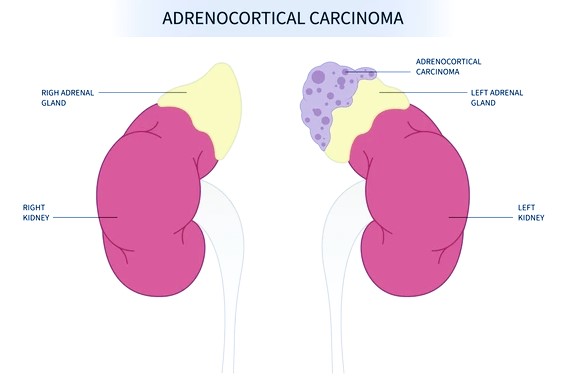 adrenocortical carcinoma