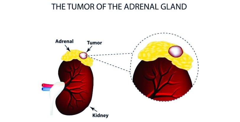 adrenal gland cancer