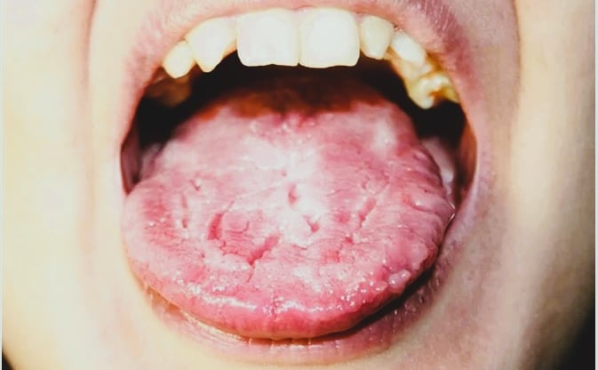 Candidiasis