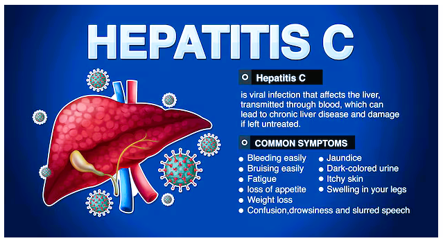 hepatitis c