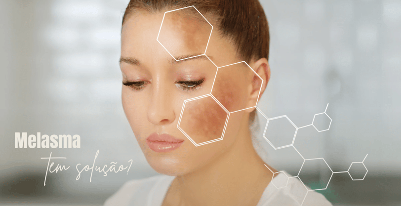 melasma no rosto