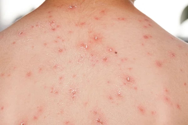 chickenpox