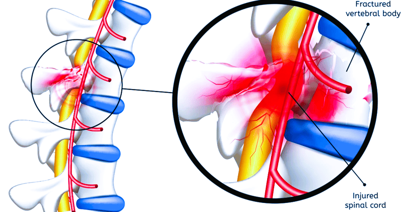 spinal cord injury