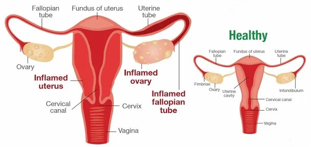 Pelvic Inflammatory Disease (PID)