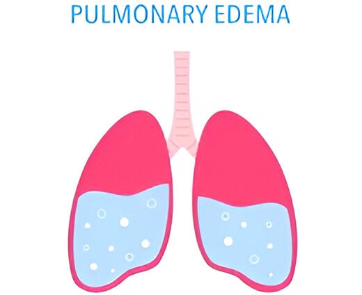 Pulmonary edema