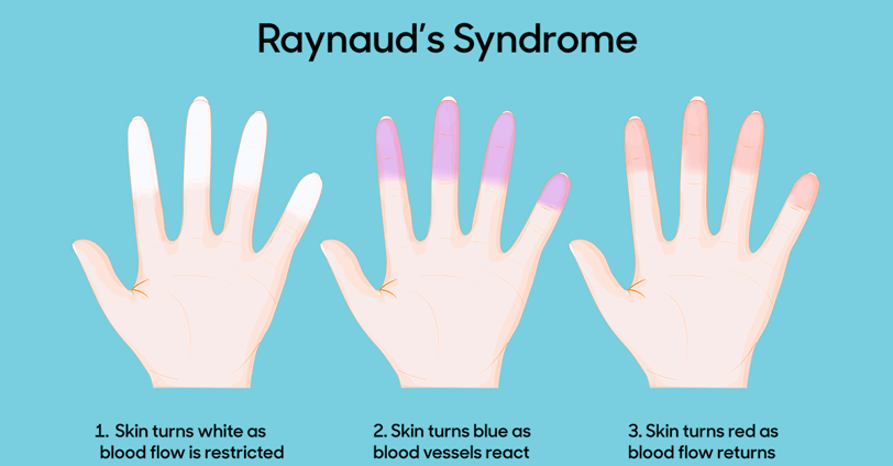 ray-syndrome