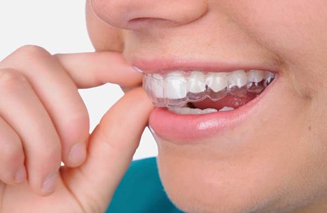 lưu ý khi niềng răng trong suốt
