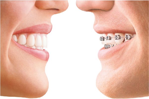 Niềng trong suốt và niềng mắc cài