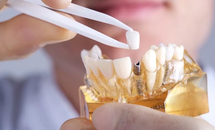 trồng răng implant