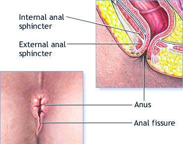 A fissures