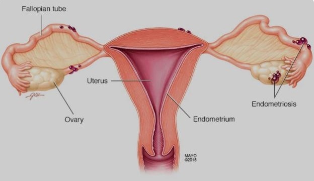 ENDOMETRIOSIS