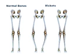 rickets