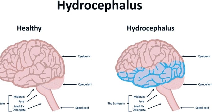 Hydrocephalus
