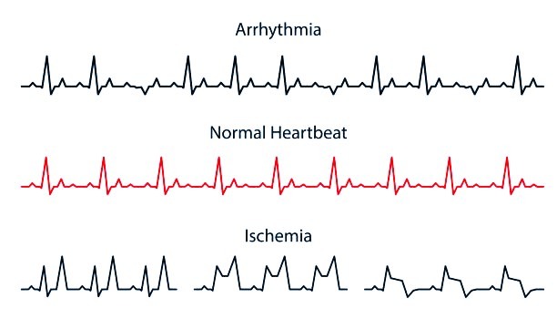 Irregular Heartbeats