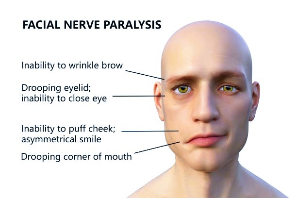 bells palsy