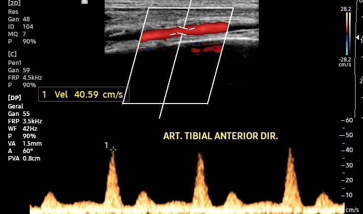 Artéria tibial anterior com fluxo normal ao Doppler