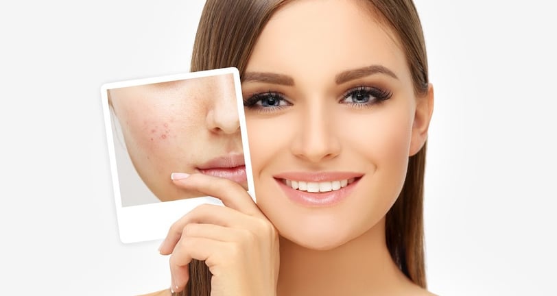 Skindent's Rejuvenate Acne Treatment Services