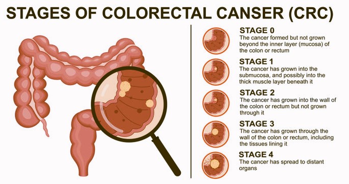 Colon Polyps