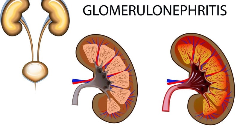 glomerulonephritis