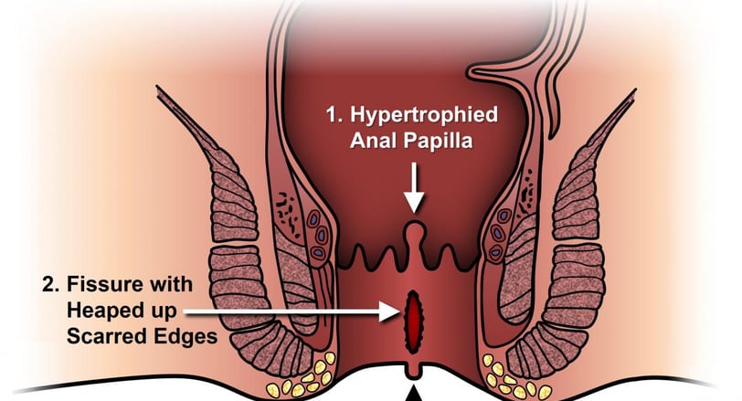 anal fissure GASTRO FOUNDATION