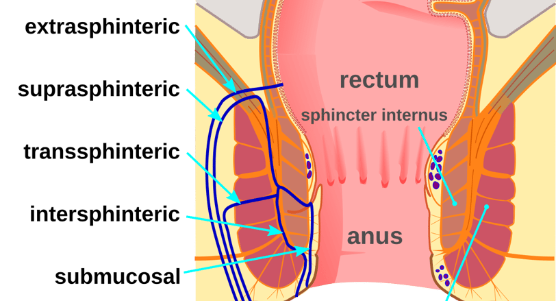anal fistula  GASTRO FOUNDATION