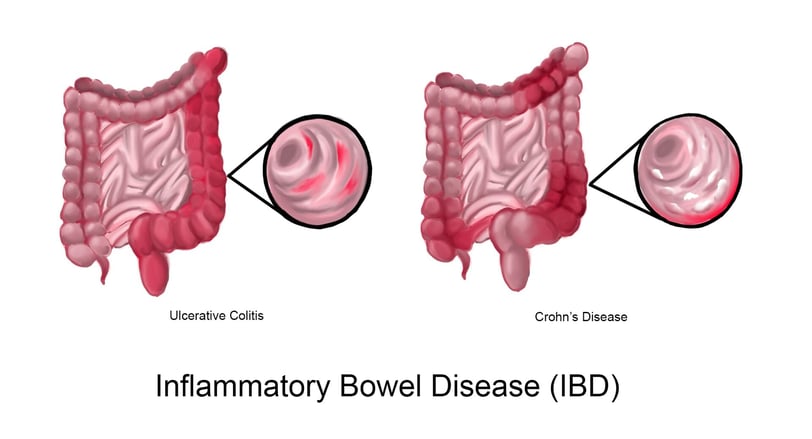 inflammatory bowel disease GASTRO FOUNDATION