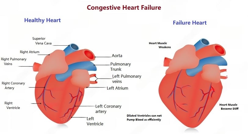Congestive Heart Failure