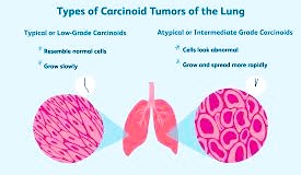 Carcinoid Tumors of the Lung