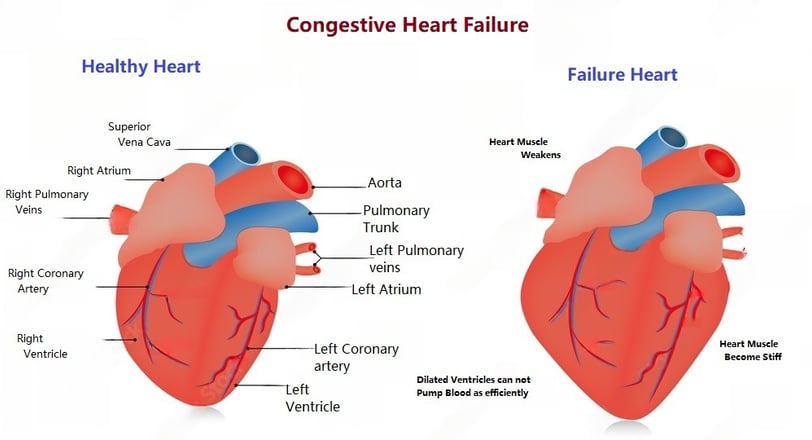 healthy and failure heart