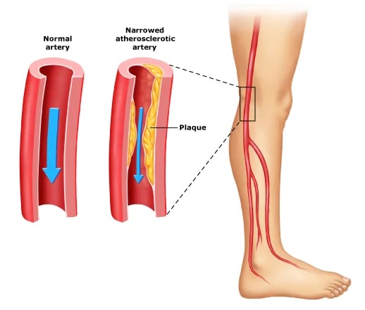 Peripheral Vascular Disease