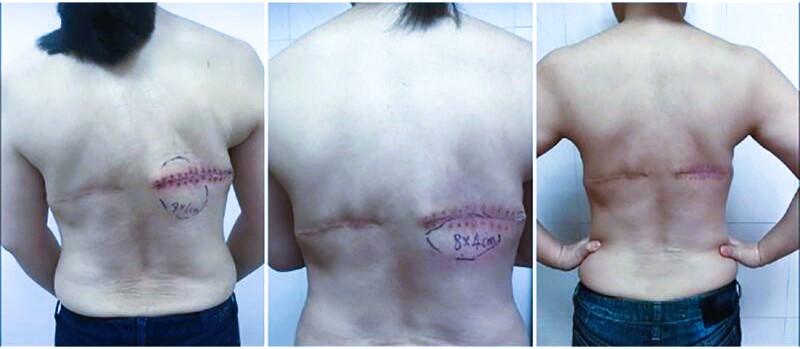 seroma