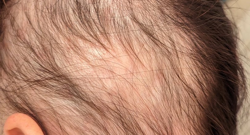 a woman with severe hairloss