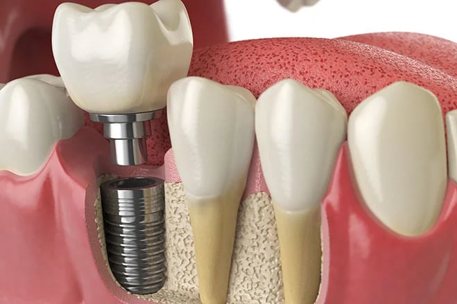 dental implant kolkata