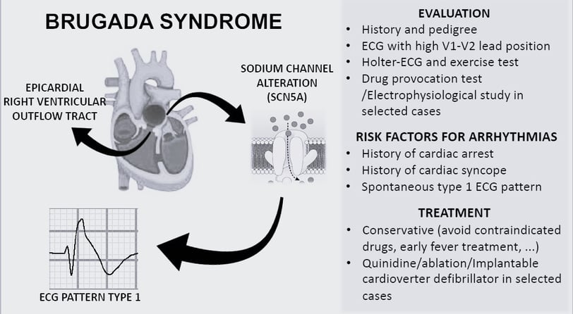 Brugada Syndrome