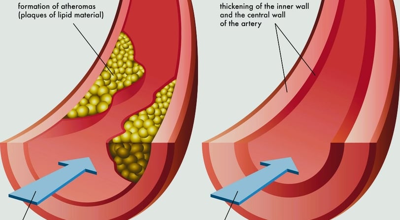 Arteriosclerosis