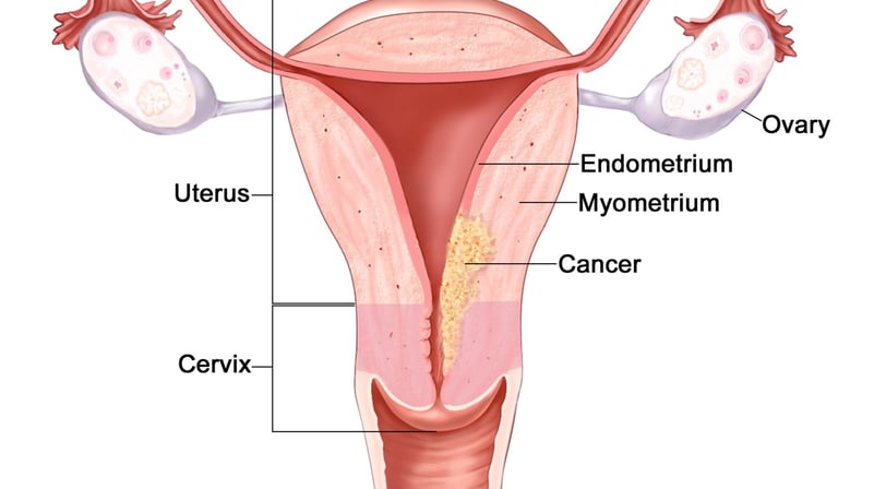 Endometrial Cancer