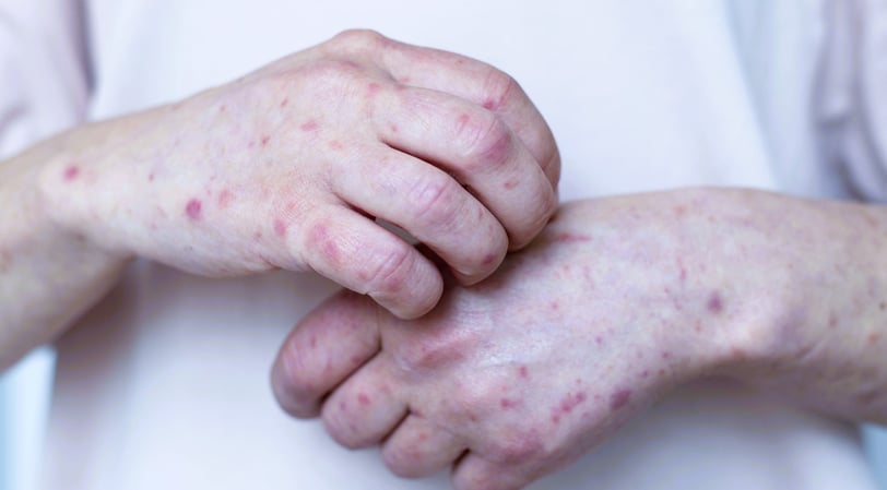 Actinic keratosis
