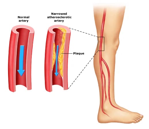 Peripheral Vascular Disease