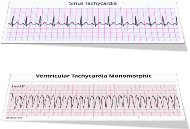 tachycardia 