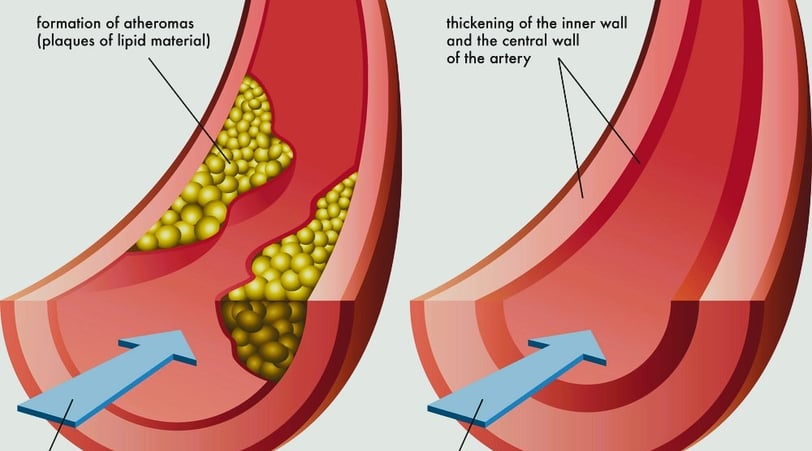 Arteriosclerosis