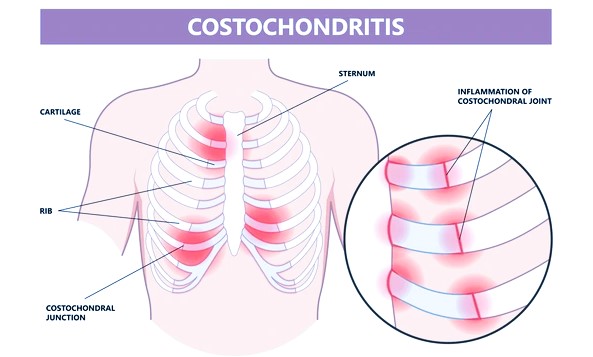 costochondritis
