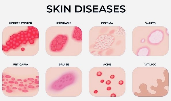 skin diseases
