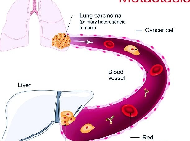 Metastatic Cancer