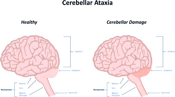 Ataxia