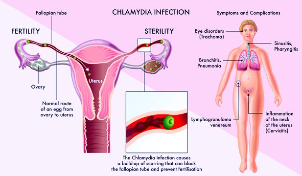 chlamydia