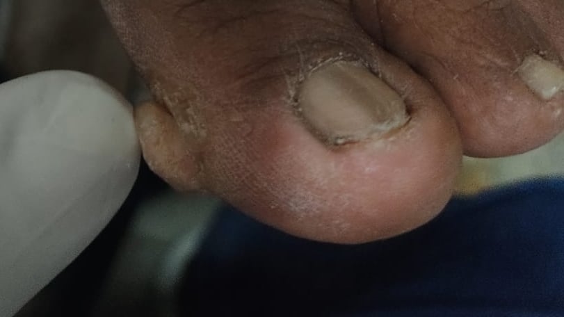 fibroqueratoma digital