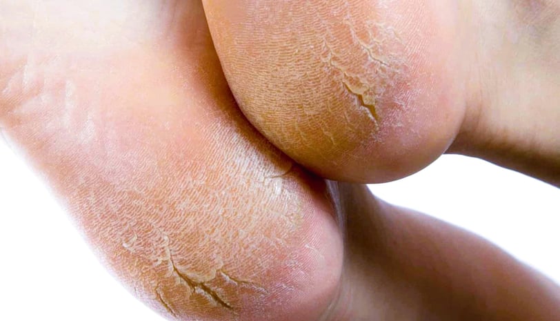 Cracked Heels