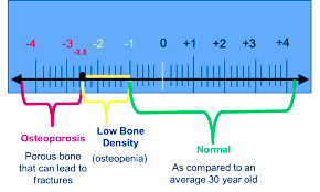 Bone Mineral Density