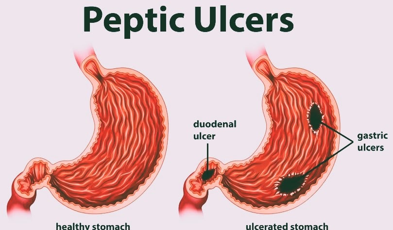 peptic ulcers