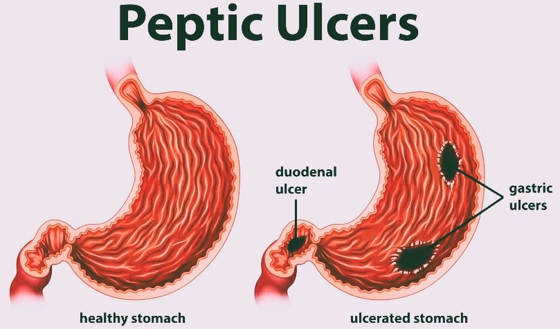 peptic ulcers